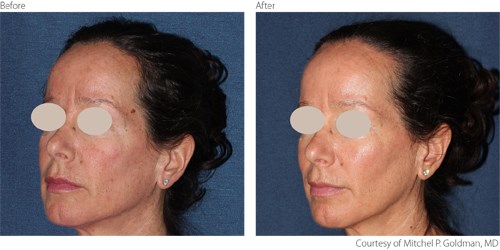 BeforeAfter4 Non-Ablative Courtesy of Mitchel P. Goldman, M.D. Before And After Non-Ablative Treatment