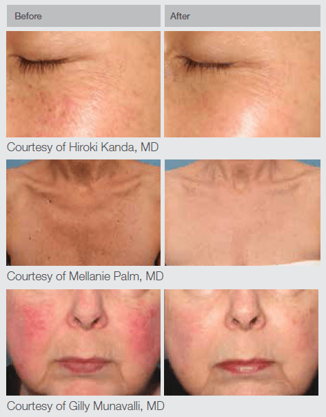 IPL- BandA pics_New_1 M22 IPL Laser Results Skin Rejuvenation