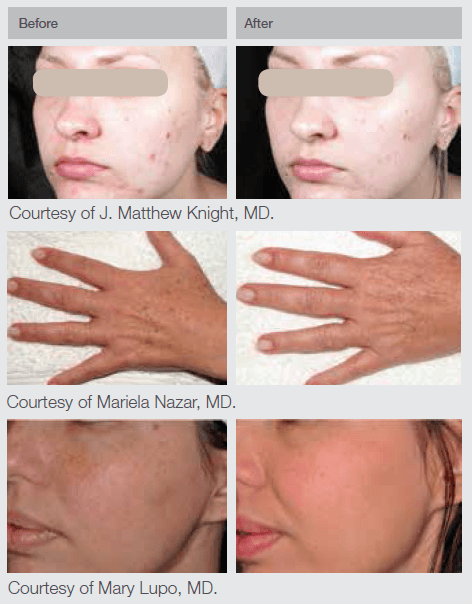 IPL- BandA pics_New_2 M22 IPL Laser Results Skin Rejuvenation