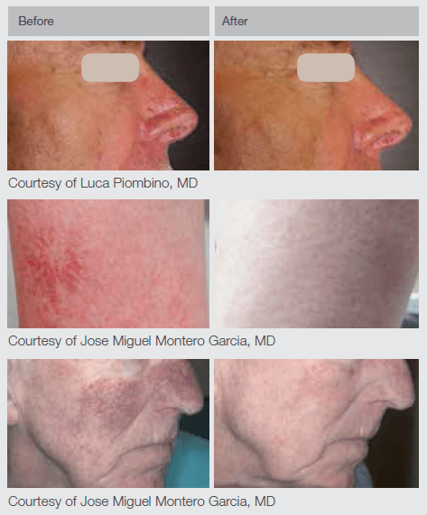 ND- BA2_New_1 Nd:YAG Laser Before and After