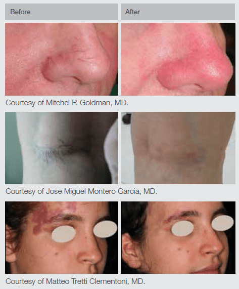 ND- BA2_New_2 Nd:YAG Laser Results