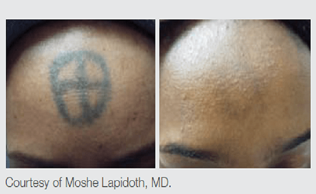 QS2_New_2 Q-Switched Nd:YAG Tattoo Removal Results