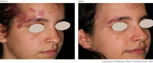 before and after Vascular Lesions treatment before and after Vascular Lesions treatment