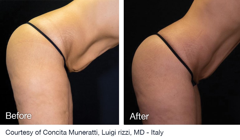 Before And After NuEra Tight Skin Smoothing Treatment Before And After NuEra Tight Skin Smoothing Treatment