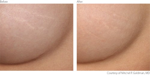 BeforeAfter-3-Non-Ablative-Courtesy-of-Mitchel-P.-Goldman-M.D. Before And After Non-Ablative Treatment