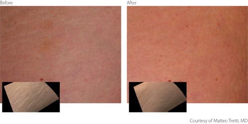 BeforeAfter2-Non-Ablative-Courtesy-of-Matteo-Tretti-Clementoni-M.D. BeforeAfter Non Ablative Treatment