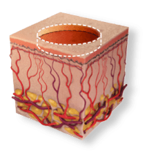 skin1 ActiveFX superficial pulse profile