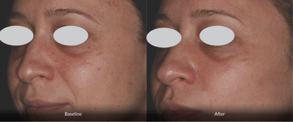 Before And After Photofabulous Treatment Before And After Photofabulous Treatment