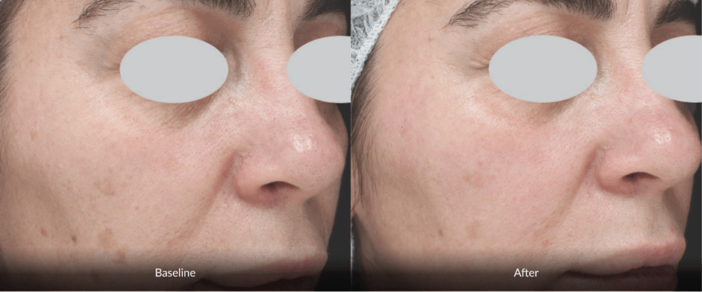 Before And After Photofabulous Treatment Before And After Photofabulous Treatment
