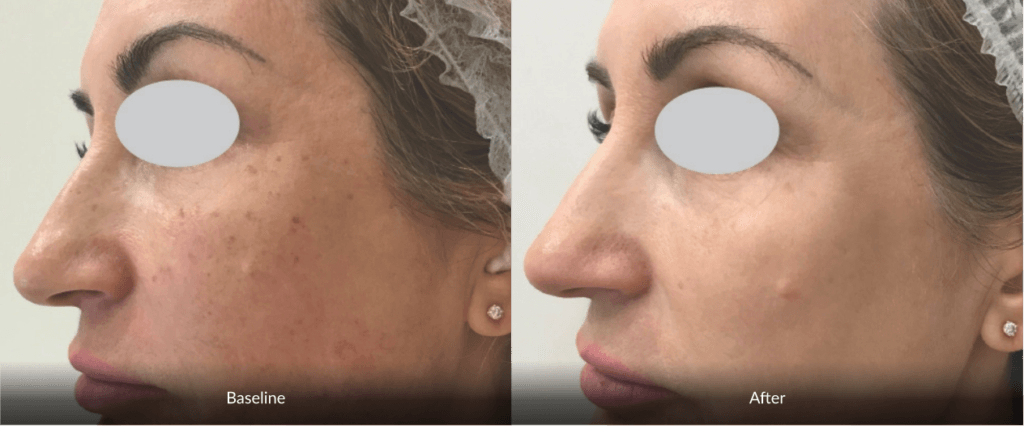 before and after Photofabulous treatment before and after Photofabulous treatment