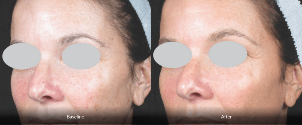 Before And After Photofabulous Treatment Before And After Photofabulous Treatment