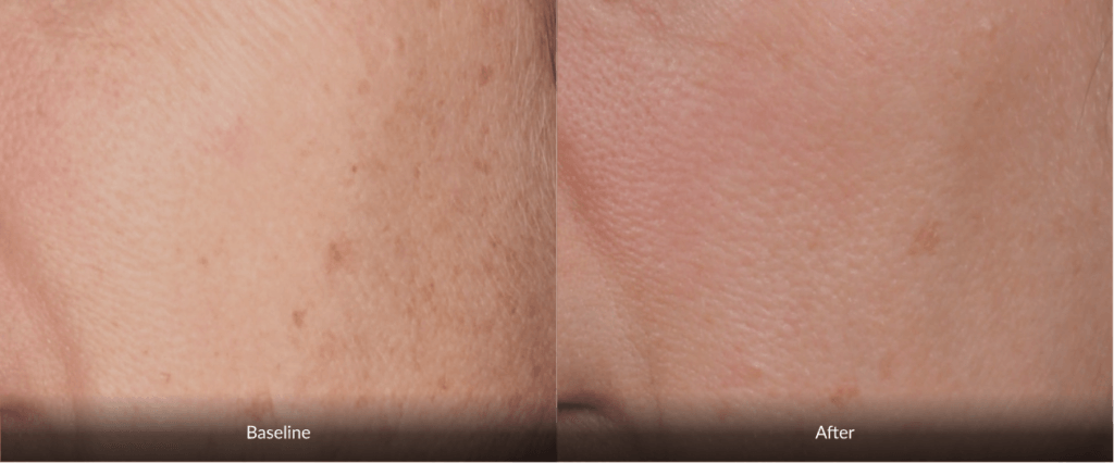 Before And After Photofabulous Treatment Before And After Photofabulous Treatment