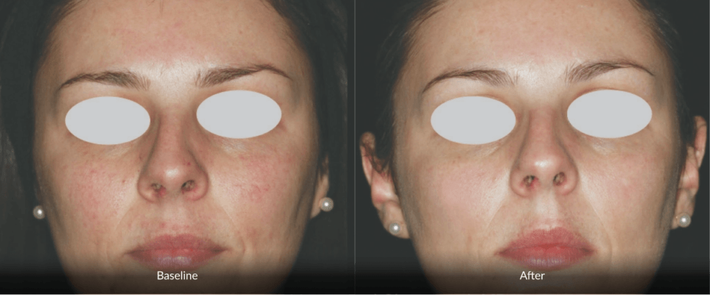 Before And After Photofabulous Treatment Before And After Photofabulous Treatment