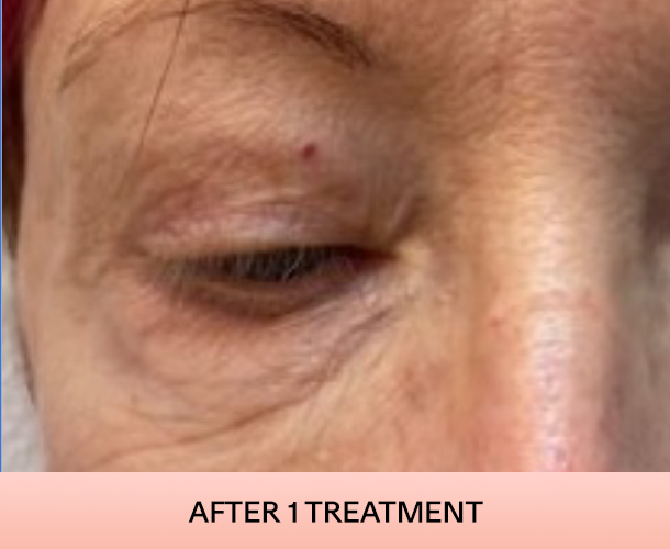 eyelid_after-2