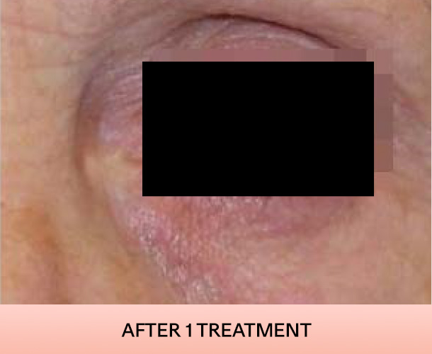 eyelid_after-3