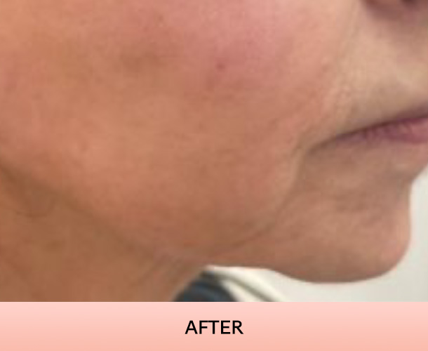 jawline_after-1 Jawline after triLift treatment