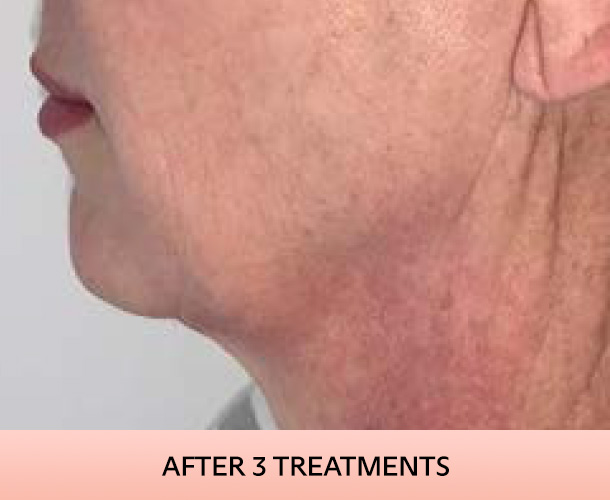 jawline_after-3 Jawline after triLift treatment