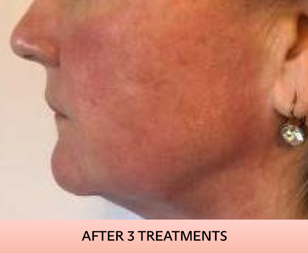 jawline_after-4 Jawline after triLift treatment