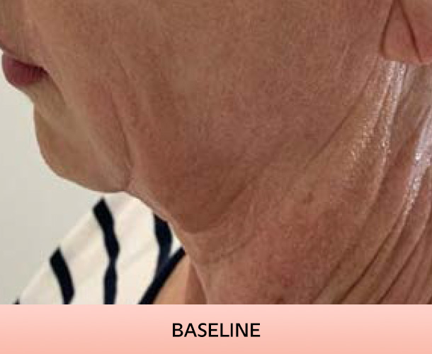 jawline_baseline-3 Jawline before triLift treatment